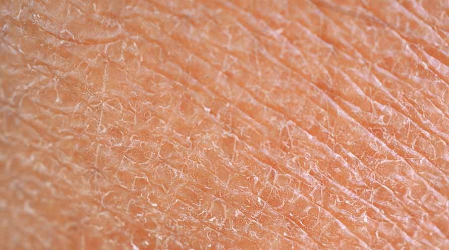 Dry Skin